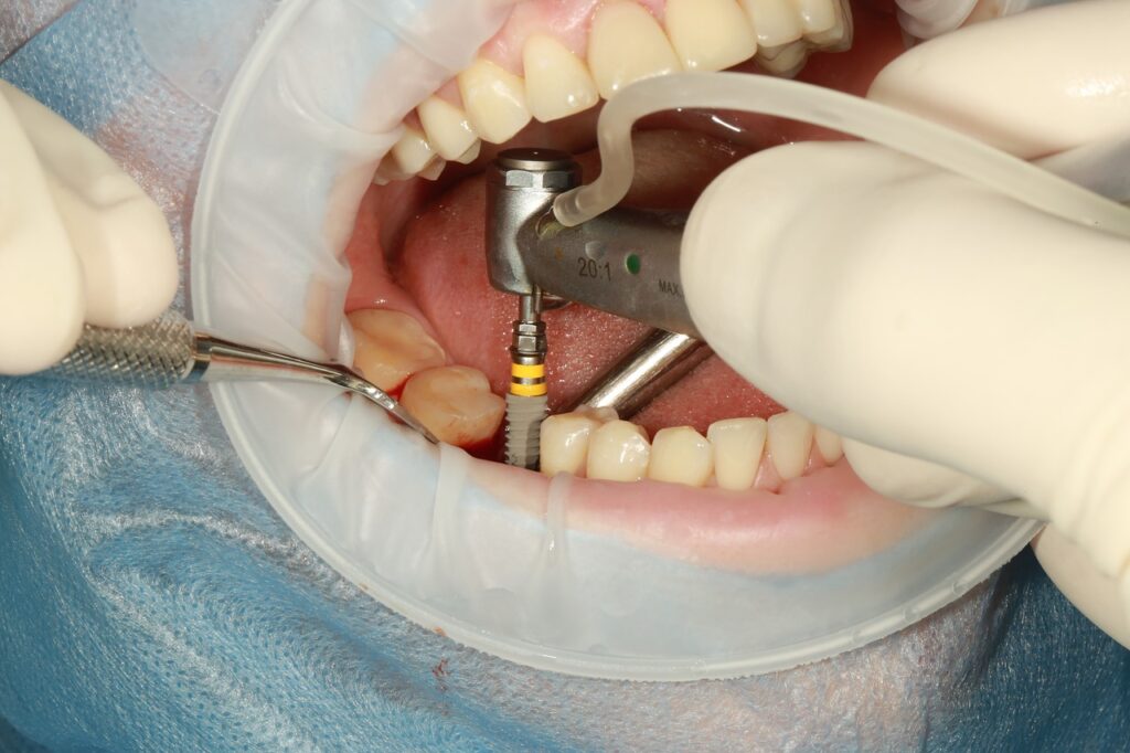 Pros And Cons Of Dental Implants 